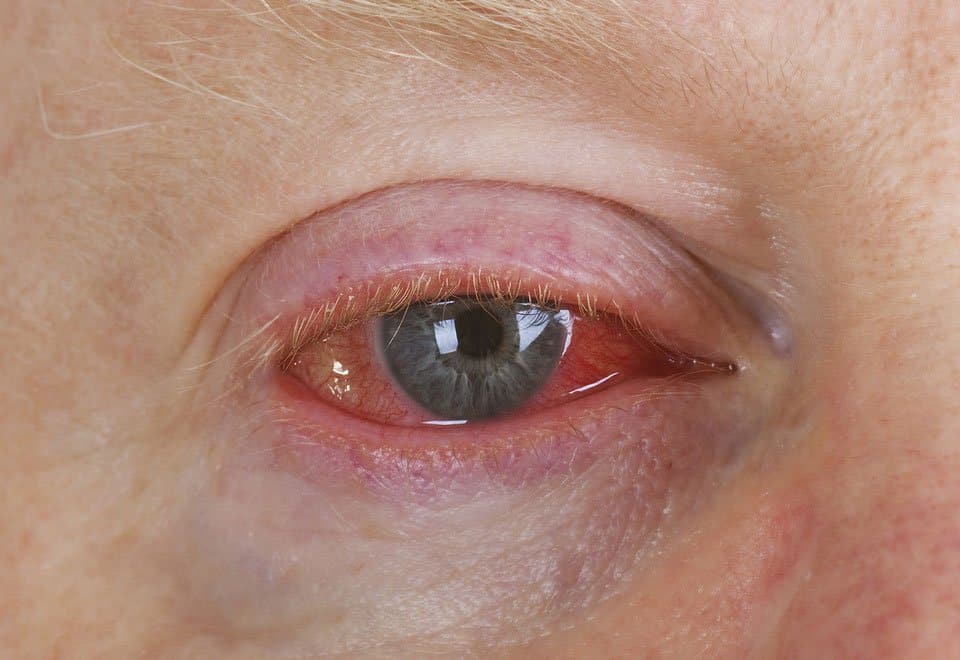 10-of-the-most-common-eye-problems-in-the-world-page-3-of-5